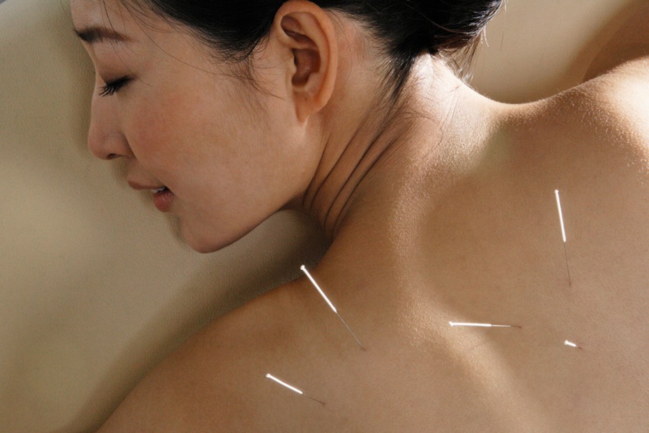 Acupuntura