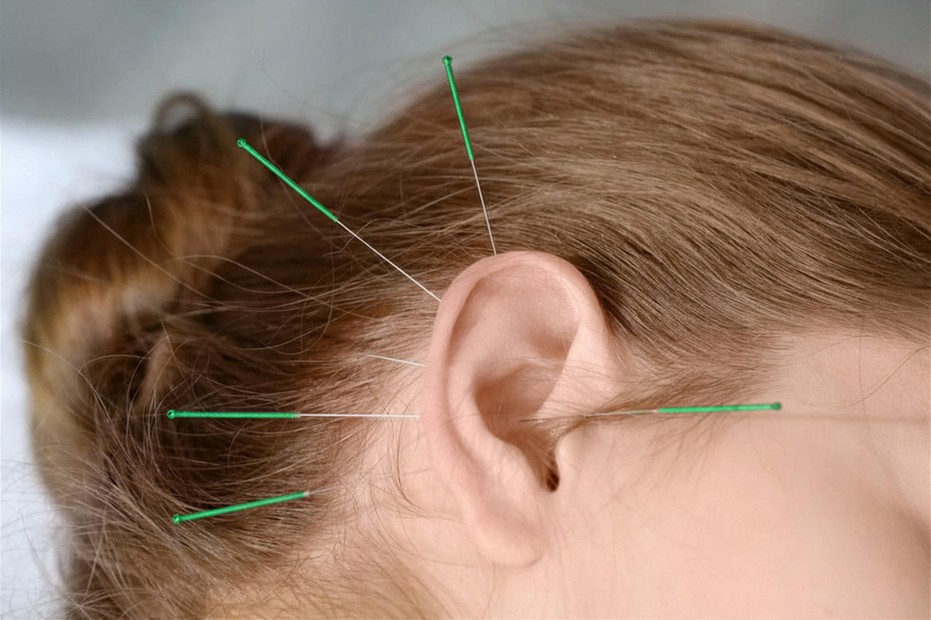 Auriculoterapia